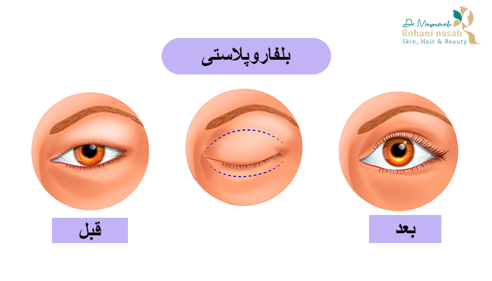 مزایای انجام عمل بلفاروپلاستی