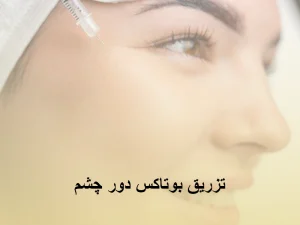 بوتاکس دور چشم