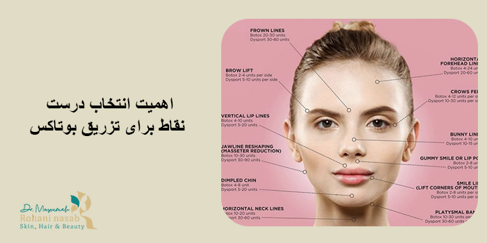 نقاط تزریق بوتاکس