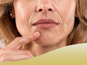 تزریق فیلر خط خنده