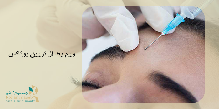 ورم بعد از تزریق بوتاکس