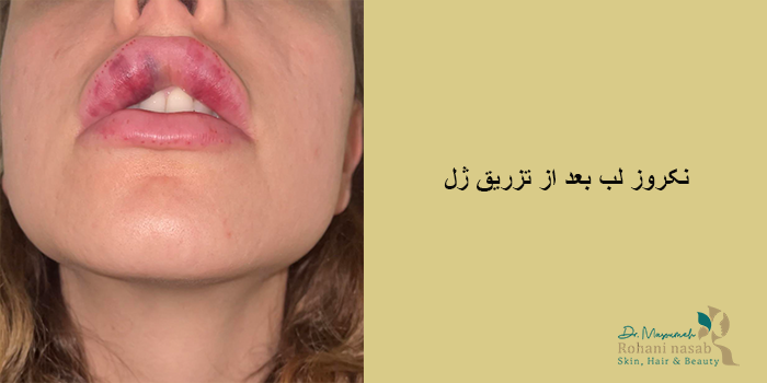 نکروز لب بعد از تزریق ژل