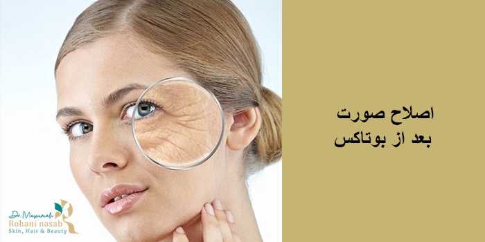 اصلاح صورت بعد از بوتاکس