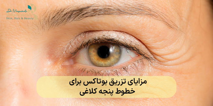 مزایای تزریق بوتاکس برای خطوط پنجه کلاغی