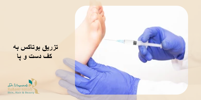 تزریق بوتاکس به کف دست و پا