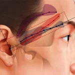 لیفت شقیقه با بوتاکس