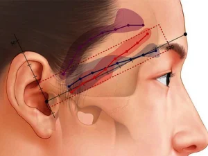 لیفت شقیقه با بوتاکس