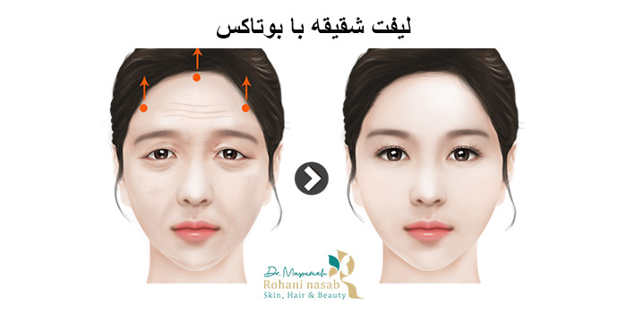 لیفت شقیقه با بوتاکس