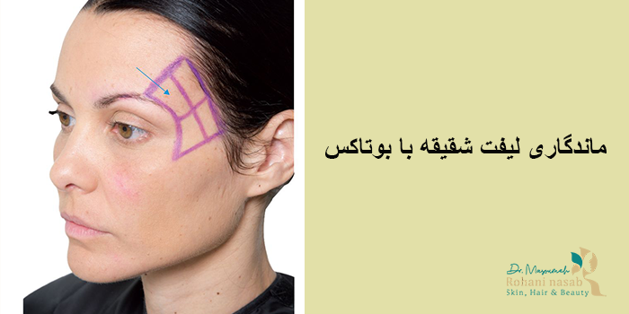 ماندگاری لیفت شقیقه با بوتاکس