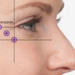 بوتاکس پنجه کلاغی