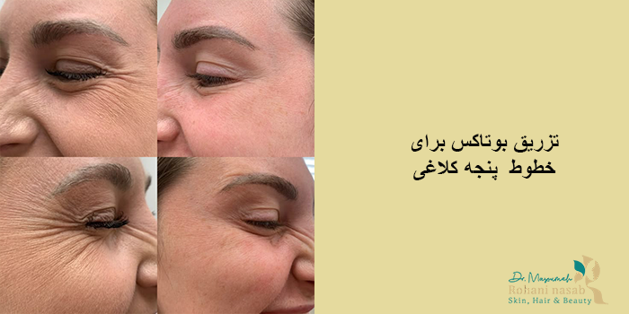 بوتاکس پنجه کلاغی
