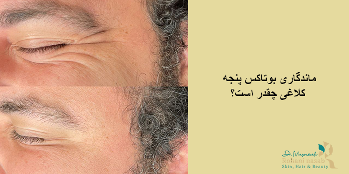 ماندگاری بوتاکس پنجه کلاغی چقدر است؟