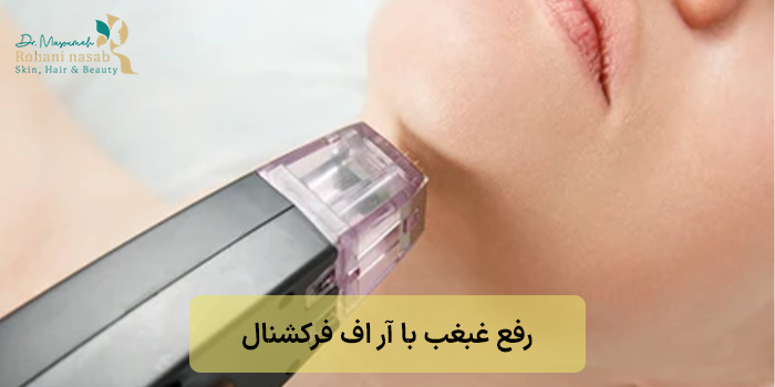 رفع غبغب با آر اف فرکشنال