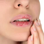 عوارض تزریق فیلر