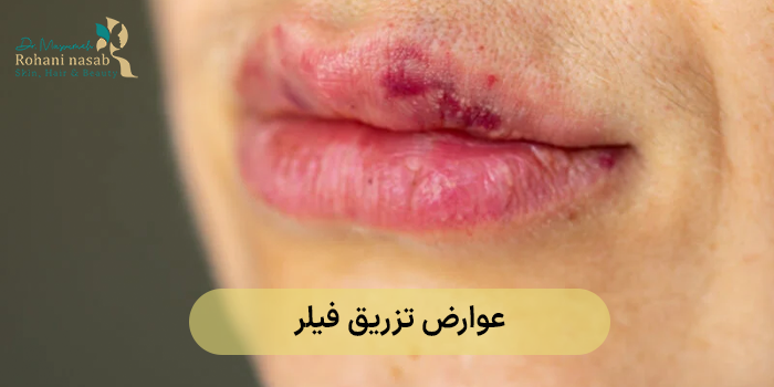6 عارضه رایج تزریق فیلر که باید از آن‌ها آگاه باشید