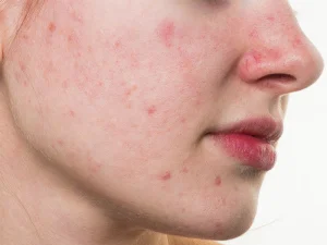 دانه های قرمز روی پوست نشانه چیست؟
