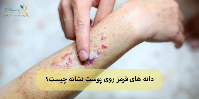 دانه های قرمز روی پوست نشانه چیست؟