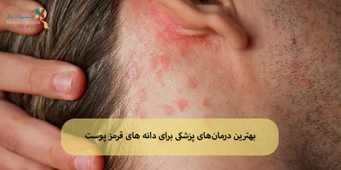 بهترین درمانهای پزشکی برای دانه های قرمز پوست