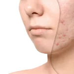 آر اف فرکشنال برای جای جوش