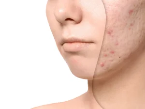 آر اف فرکشنال برای جای جوش