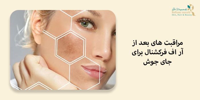 مراقبت های بعد از آر اف فرکشنال برای جای جوش